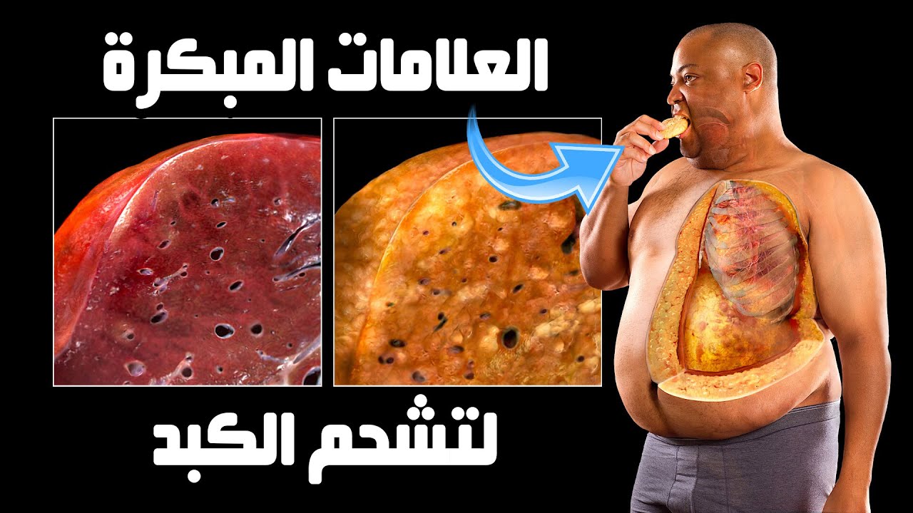 درجات تشحم الكبد وأعراض كل درجة | درجات دهون الكبد والكوليسترول وكيفيه العلاج المتكامل