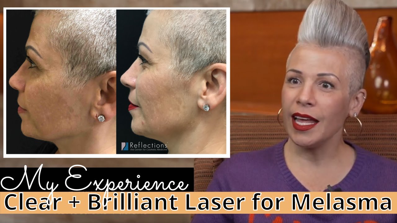 Kimberly's Experience with Clear + Brilliant Laser for Melasma [My Experience]