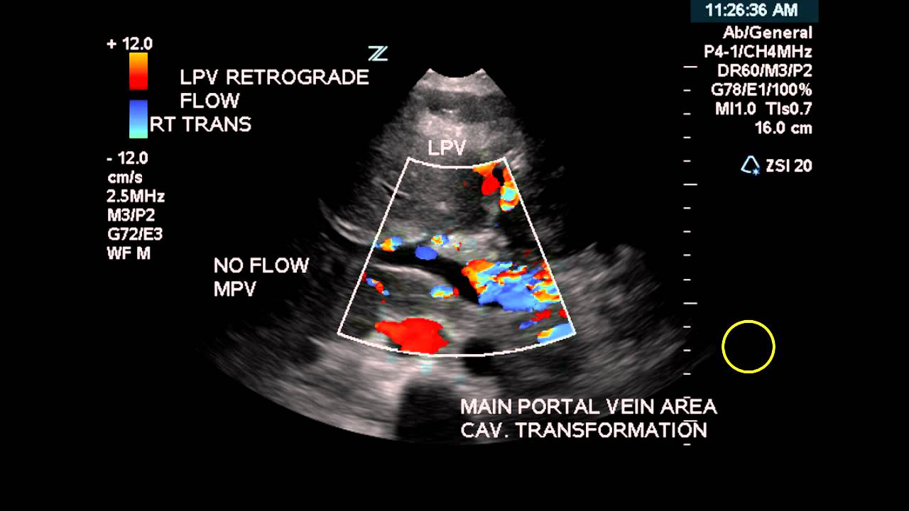Color Doppler of Cavernous Transformation of the Portal Vein - Case Study