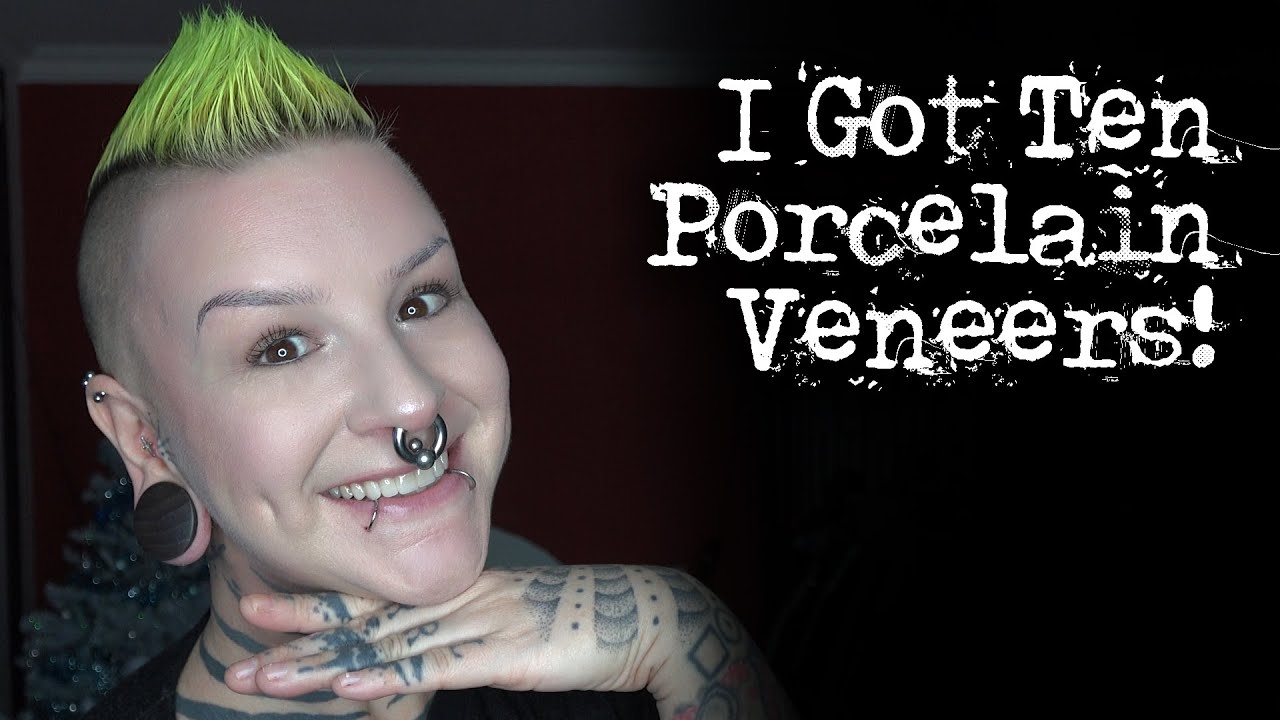 I got 10 porcelain veneers - let's talk about it!