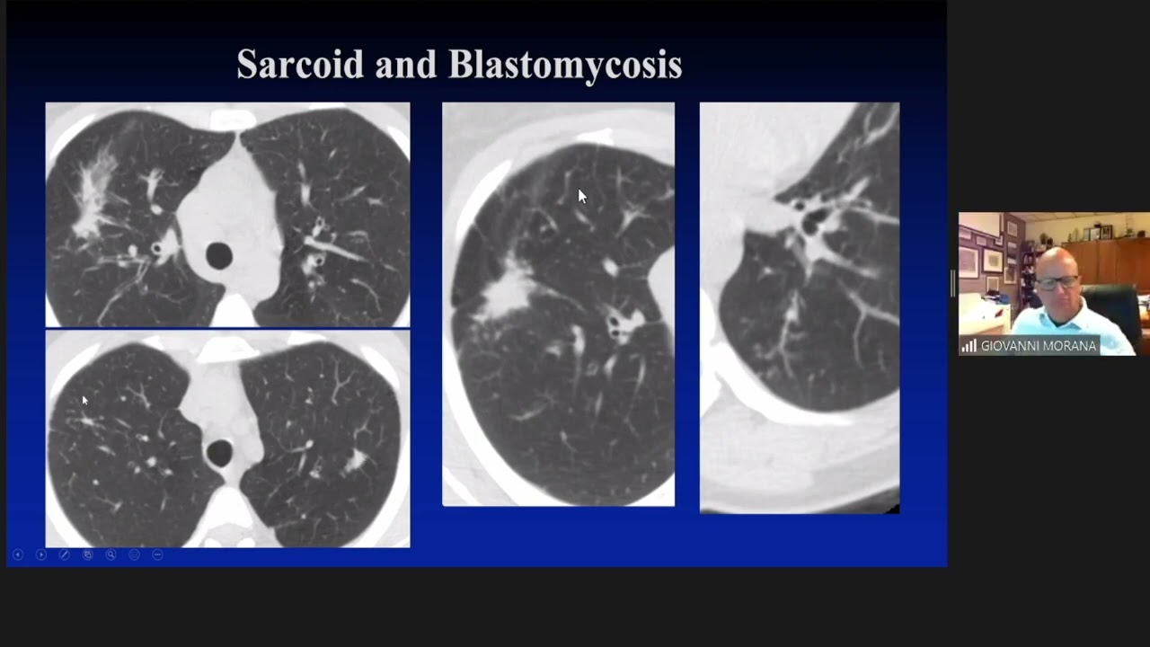 Oncological Imaging: Practical Approach - 'Mimics of Malignancy: Lung and pleura', by Dr Luba Frank