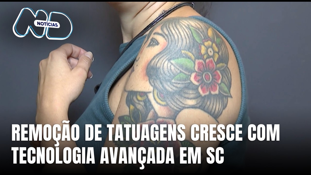 Remoção de tatuagens cresce em SC com tecnologias cada vez mais avançadas