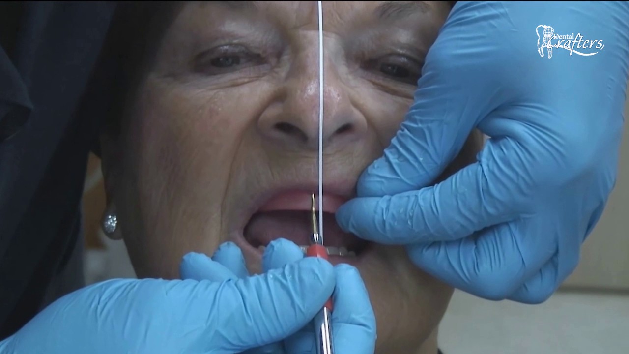 Guide to the Ideal Denture