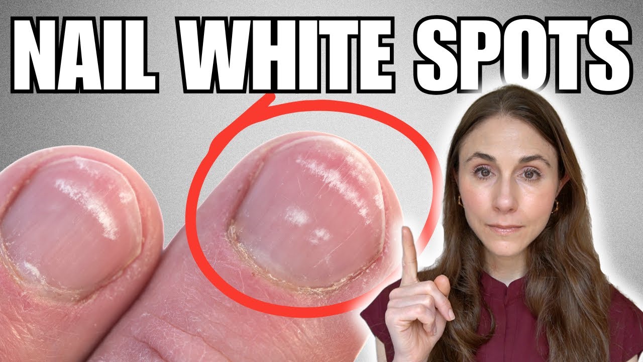 What Those White Spots on Your Nails Really Mean