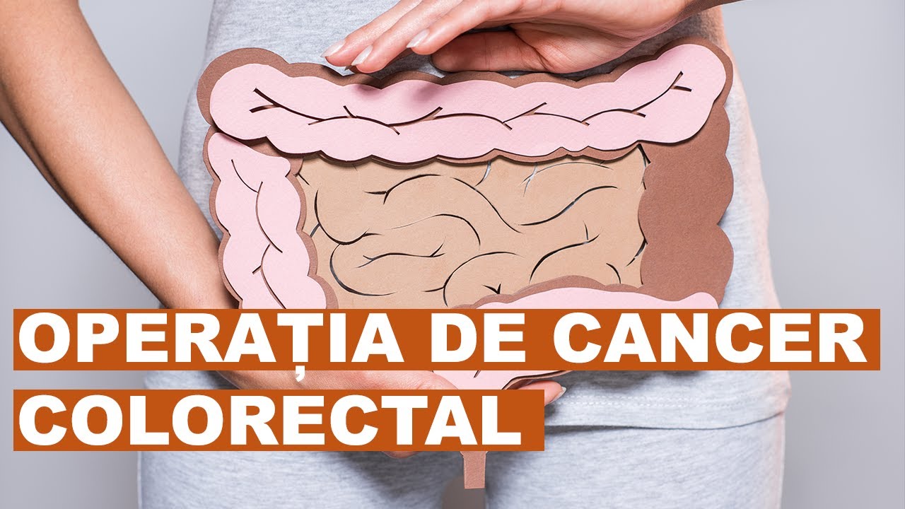 Cancerul colorectal: când se operează minim invaziv