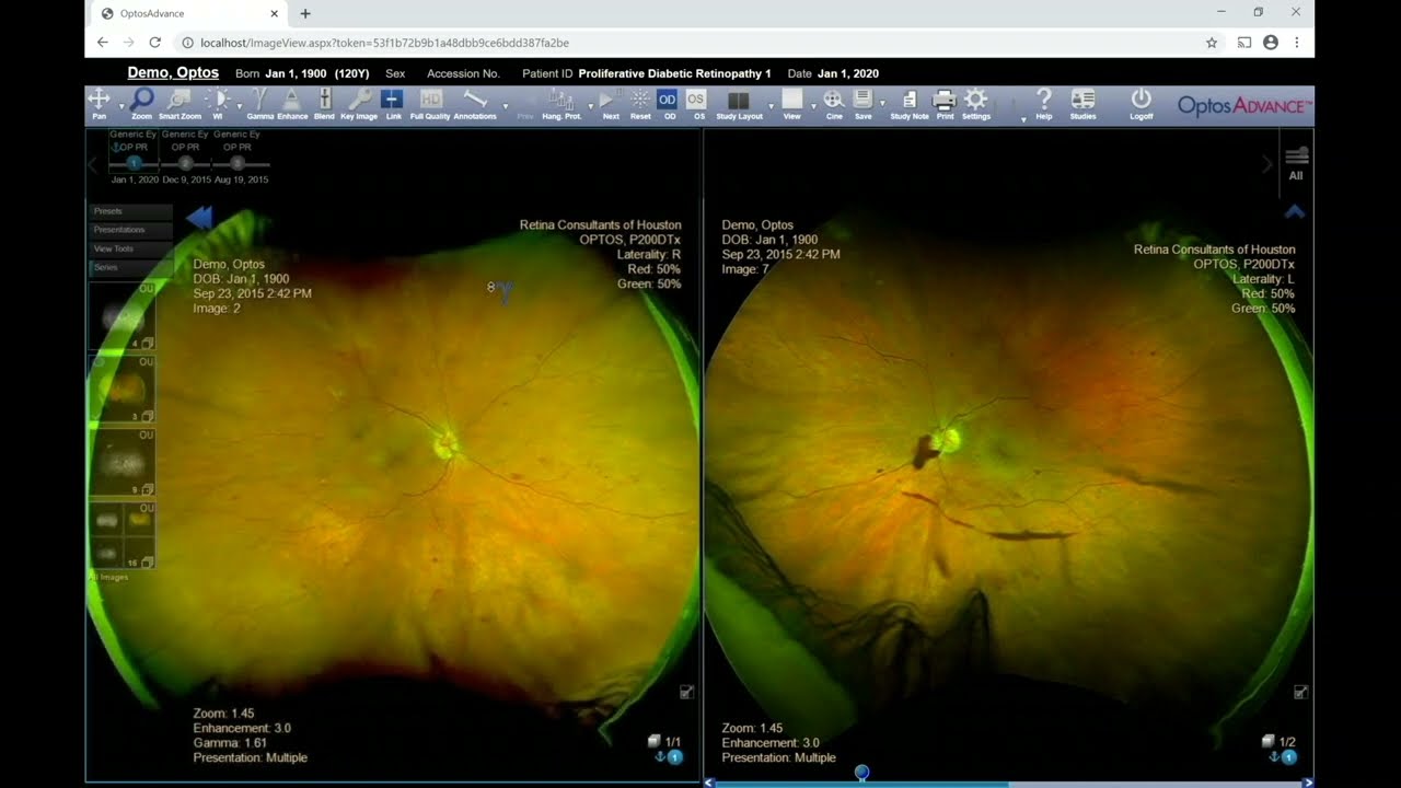 Official Optos OptosAdvance Training Video