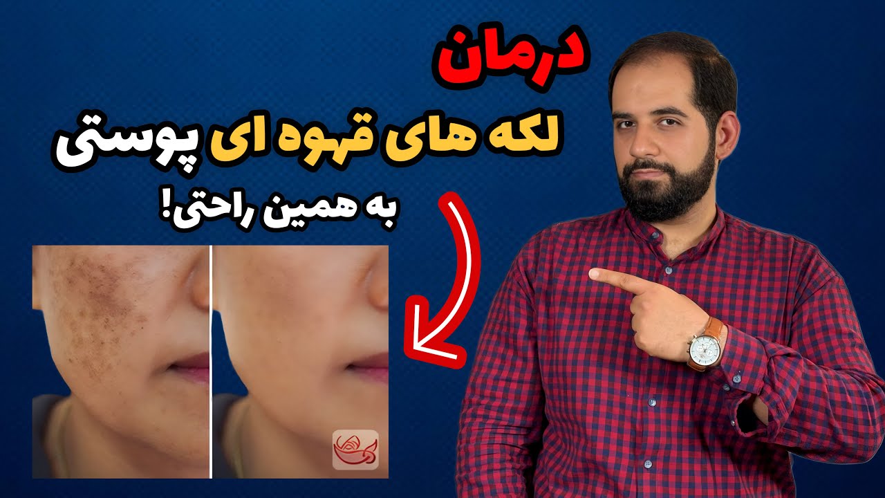درمان تضمینی لکه های پوستی و لکه های قهوه ای بدون دارو و لیزر با این روش معجزه آسا