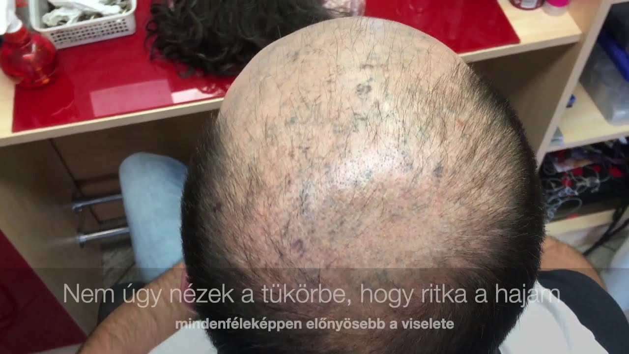 HairContrast hajpótlás megoldások: #Hajprotézis