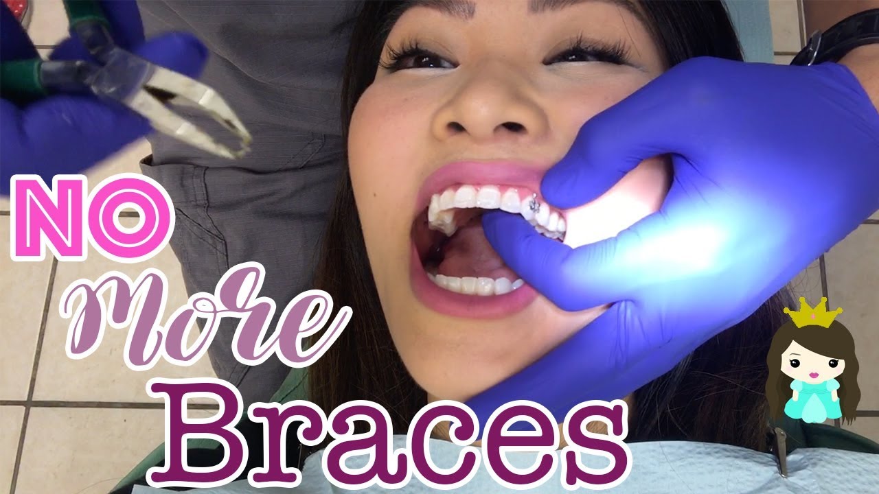 No More Braces! Getting my braces taken off Vlog!