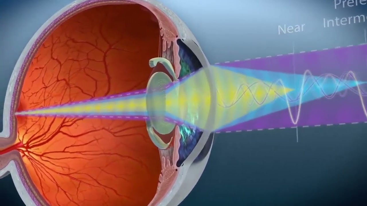 TRIFOCAL – Alcon PANOPTIX