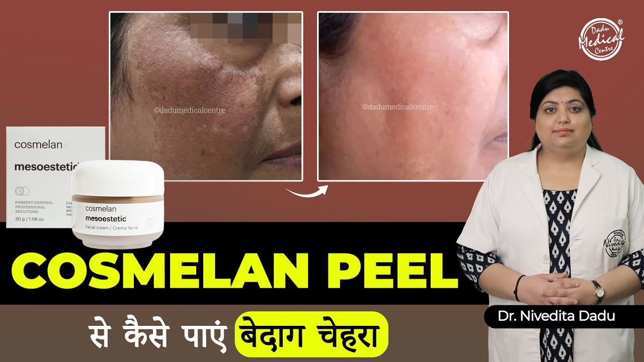 Cosmelan Peel for Pigmented Skin | Cosmelan Peel Treatment | Dadu Medical Centre