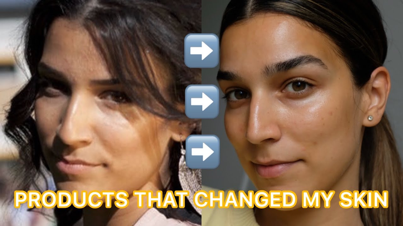 HOW I CLEARED MY ACNE PRONE SKIN I CONGESTED, DRY, DEHYDRATED, DULL