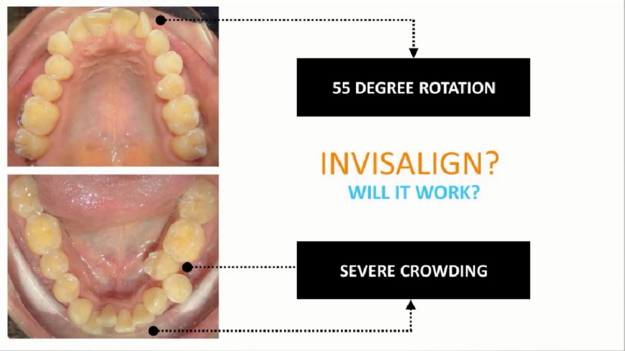 Dr  Ibrahim Invisalign Case Review Rotations With AcceleDent