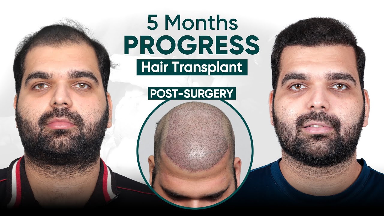 Hair Transplant in Rourkela | Best Results & Cost of Hair Transplant in Rourkela
