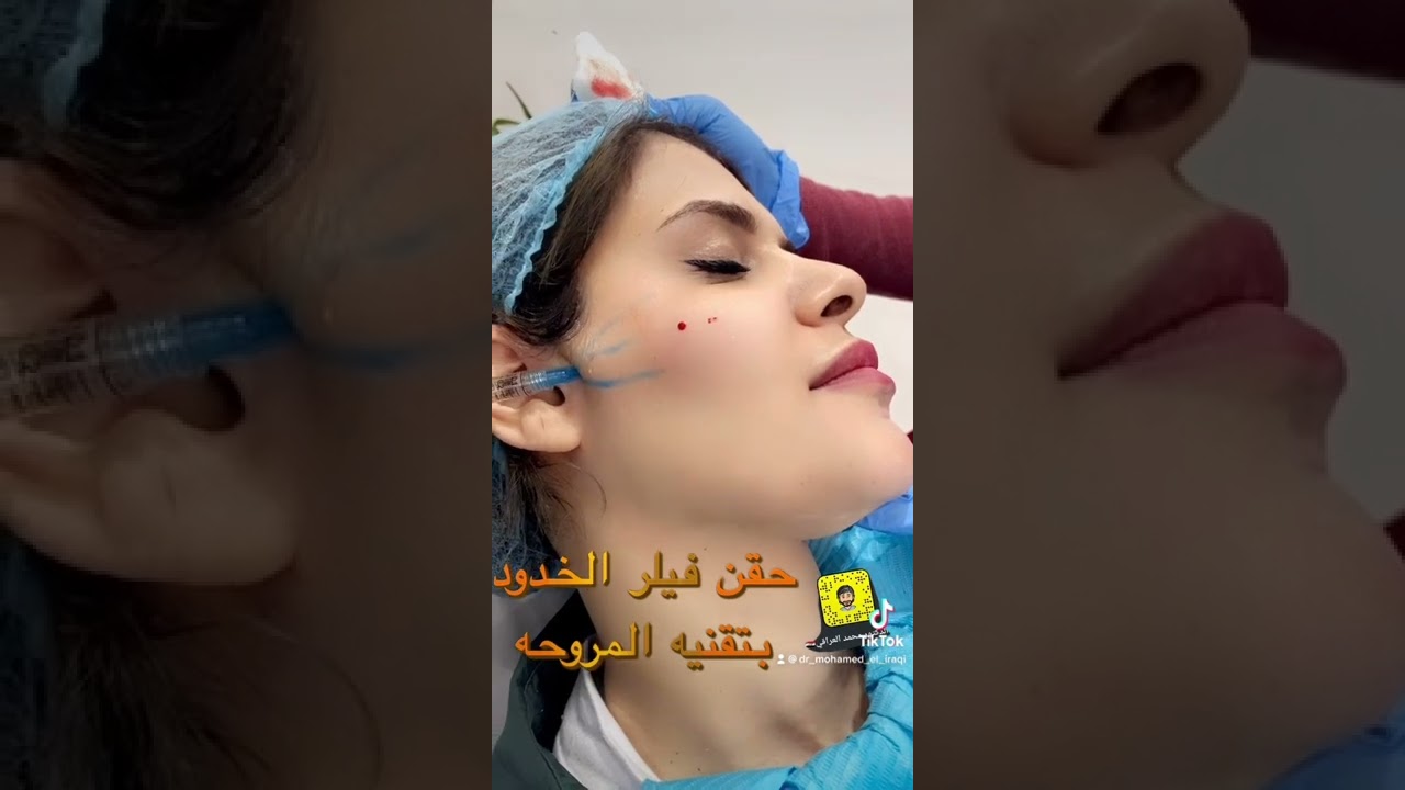 شد الوجه بالفيلر