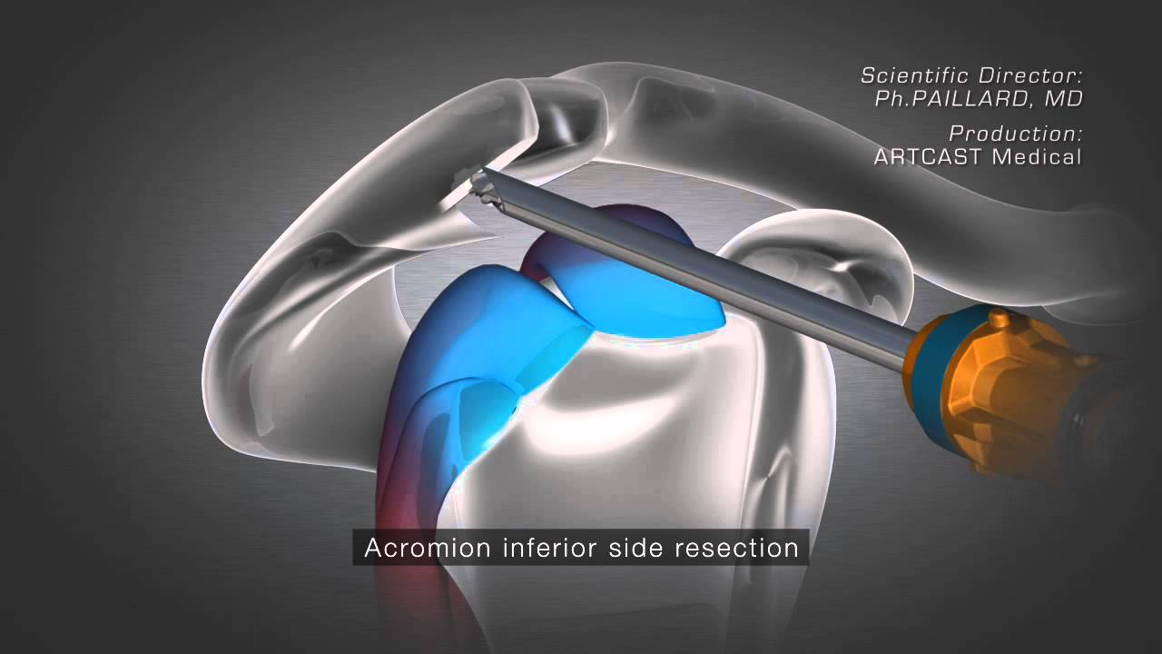 Shoulder Arthroscopy - Acromioplasty