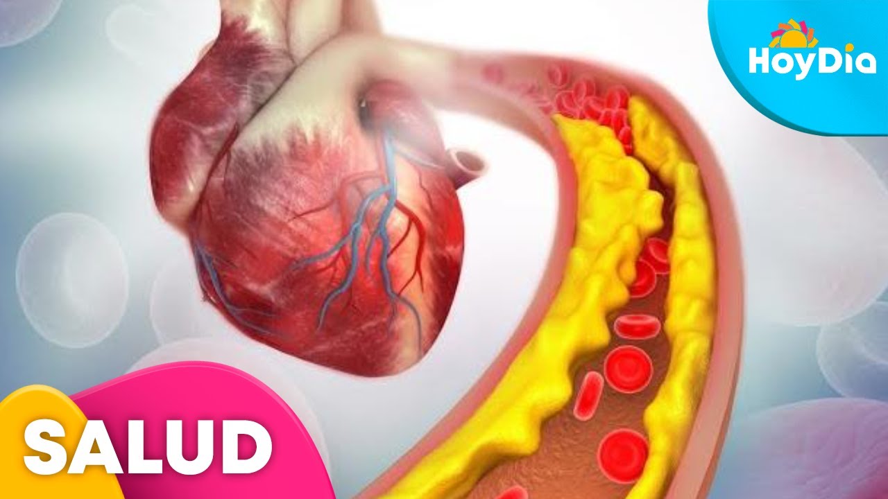 &iquest;Qu&eacute; es la vasculitis y que cu&aacute;les son sus consecuencias? Aqu&iacute; te decimos | Hoy D&iacute;a | Telemundo