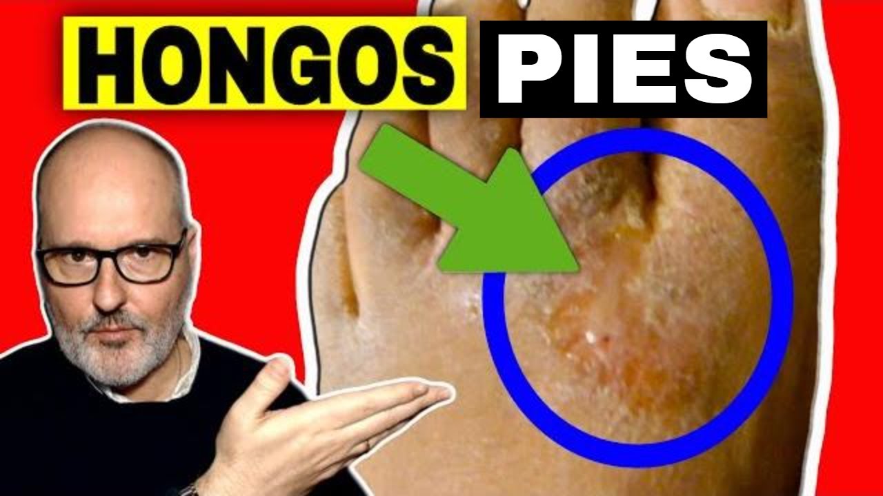 HONGOS EN LOS PIES: C&Oacute;MO ELIMINARLOS, S&Iacute;NTOMAS Y CAUSAS (PIE DE ATLETA)