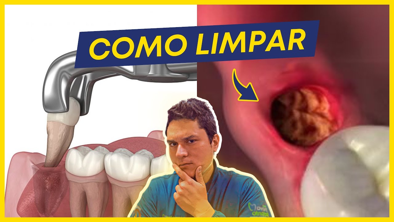 Como LIMPAR o BURACO da EXTRAÇÃO do SISO do jeito certo?