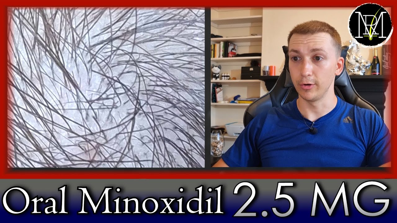 My experience with Oral Minoxidil (Loniten) in 1 month