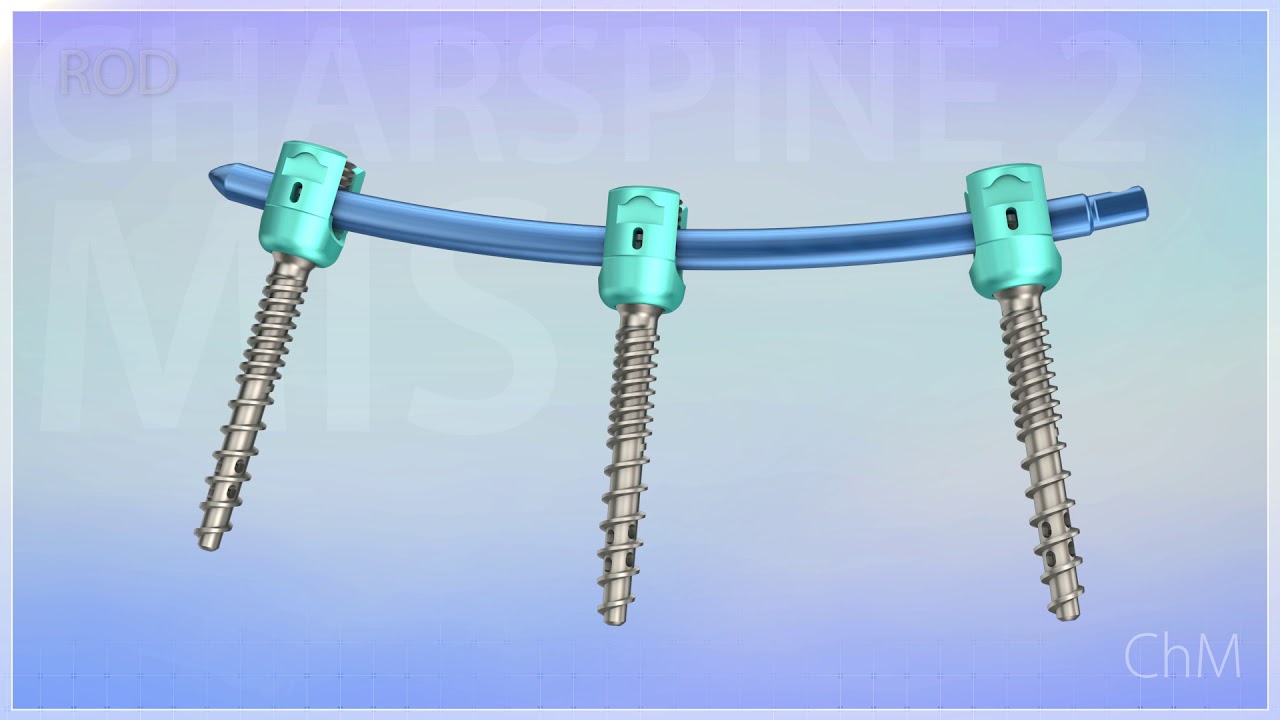 CHARSPINE2 MIS - Minimally Invasive Surgery