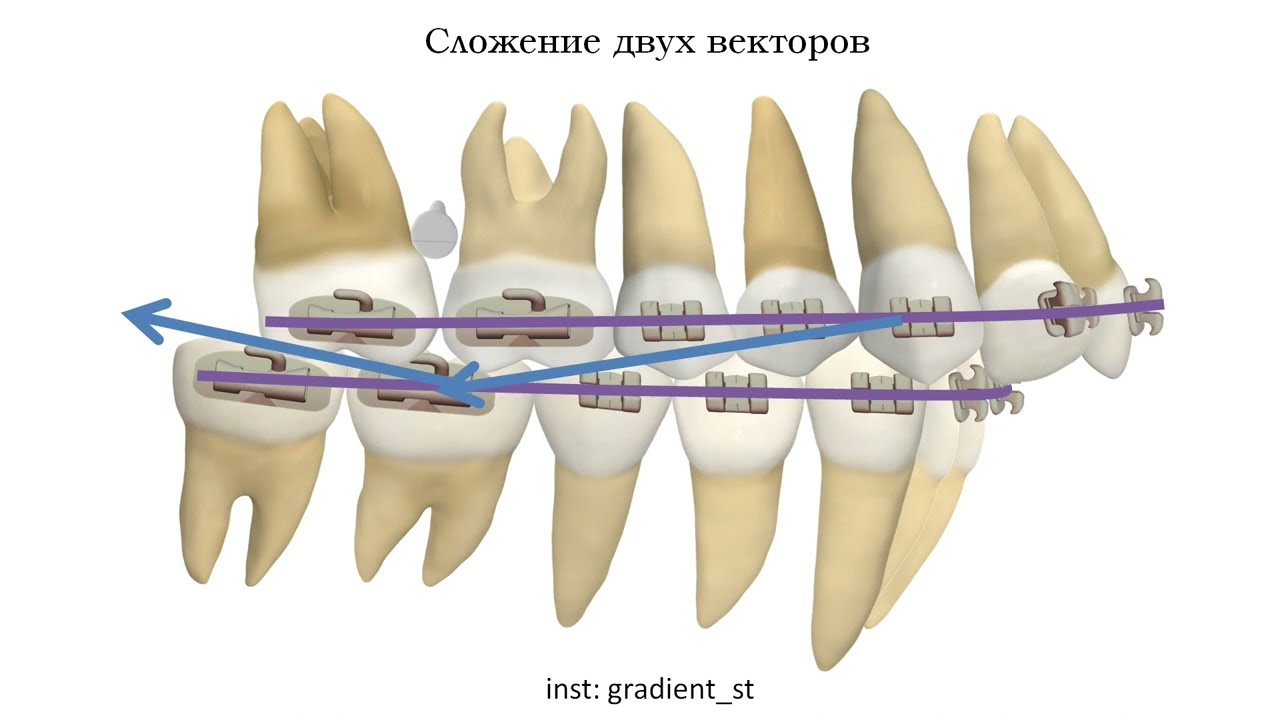 Сложение векторов в ортодонтии
