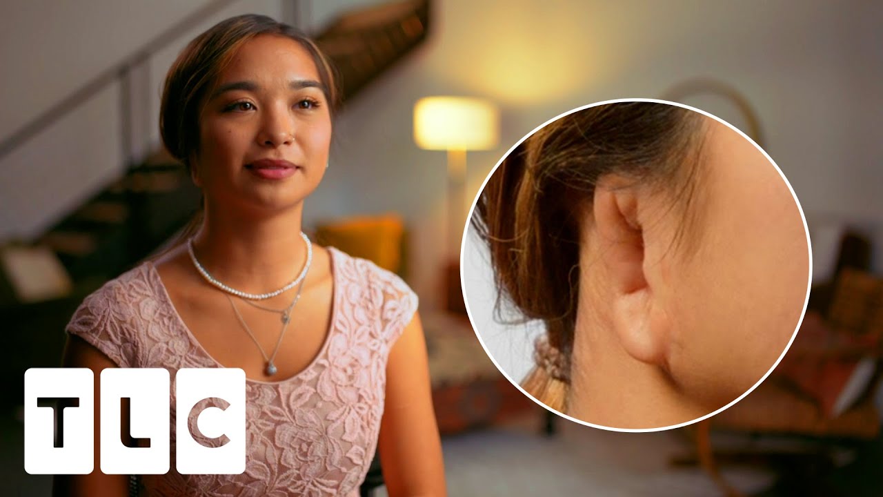 Microtia Leaves Her Without Her Right Ear And Lacking Confidence l Body Parts