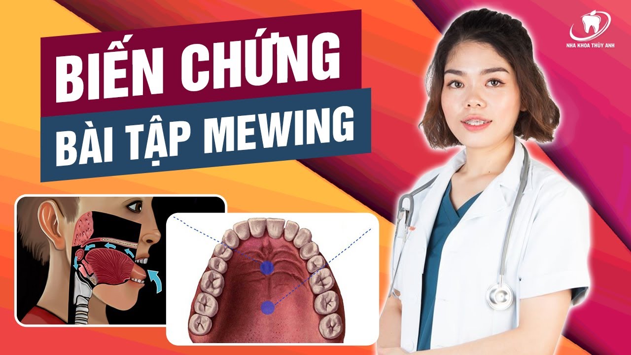 Biến chứng và ngộ nhận về tập Mewing