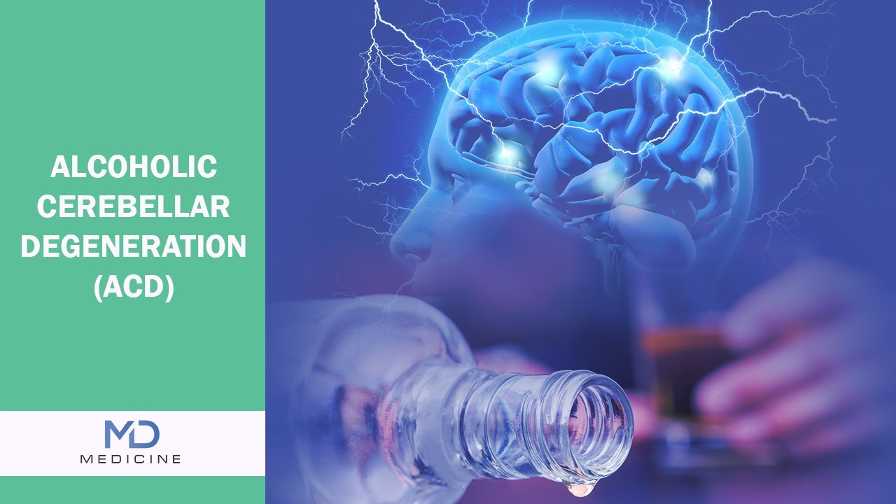 Alcoholic Cerebellar Degeneration - @mdmedicine.network