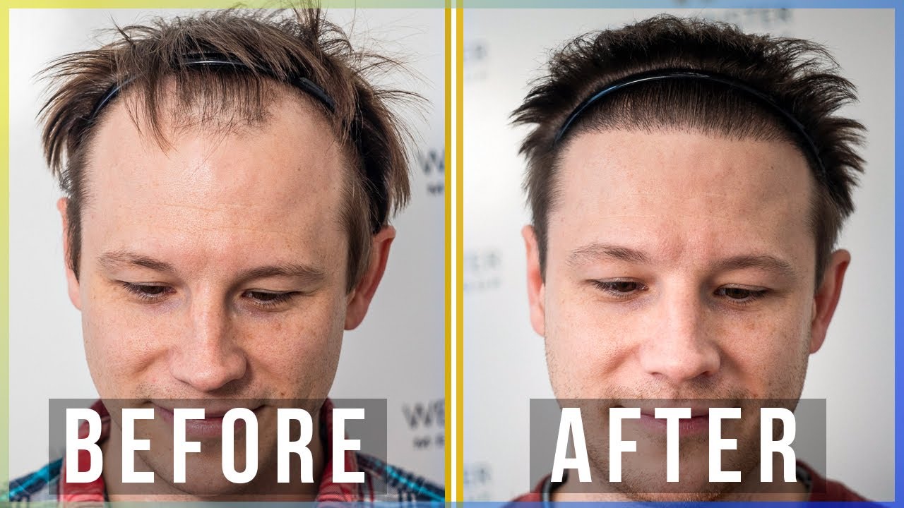 Hair Transplant Renewed My Confidence | Real Patient Story