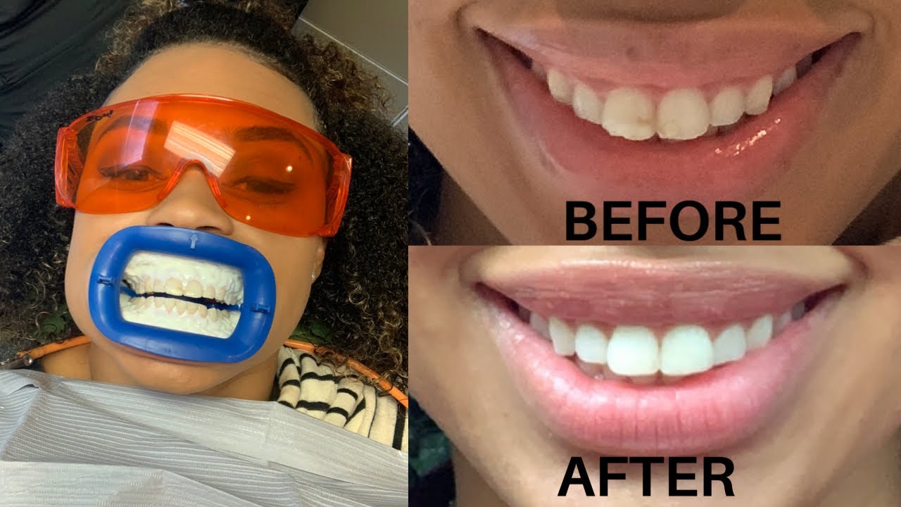 GETTING MY TEETH FIXED! No Veneers | Icon & bonding treatment