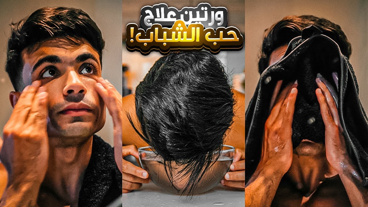 علاج حب الشباب والآثار بسرعة | روتين عملي بدون مخاطر