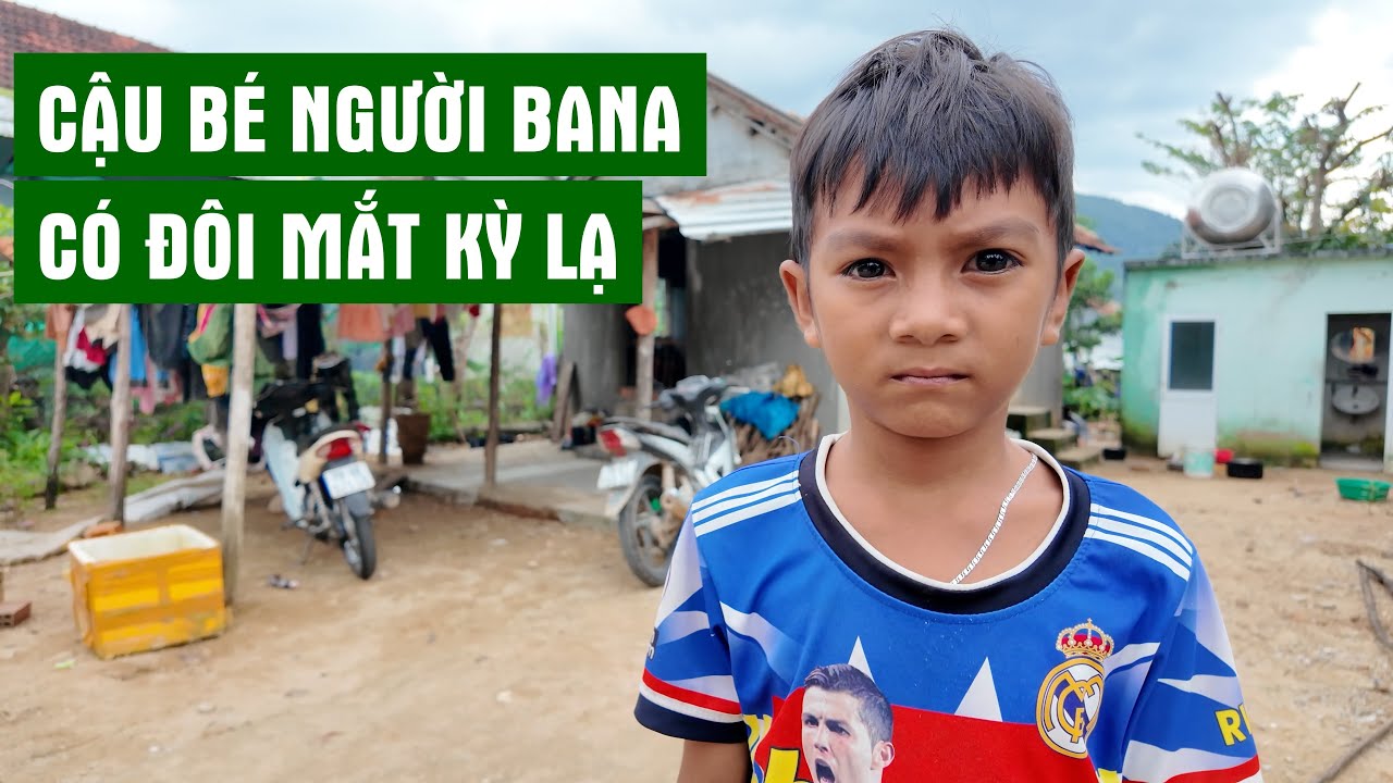 Cậu Bé Người BaNa Có Đôi Mắt Kỳ Lạ | Người Đặc Biệt
