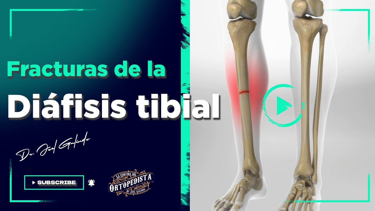 Fracturas de la diáfisis tibial