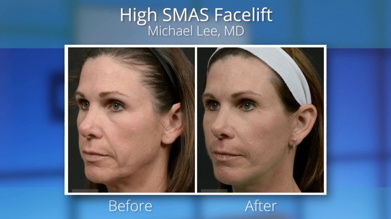 Upper Facelift or High SMAS for Facial Rejuvenation