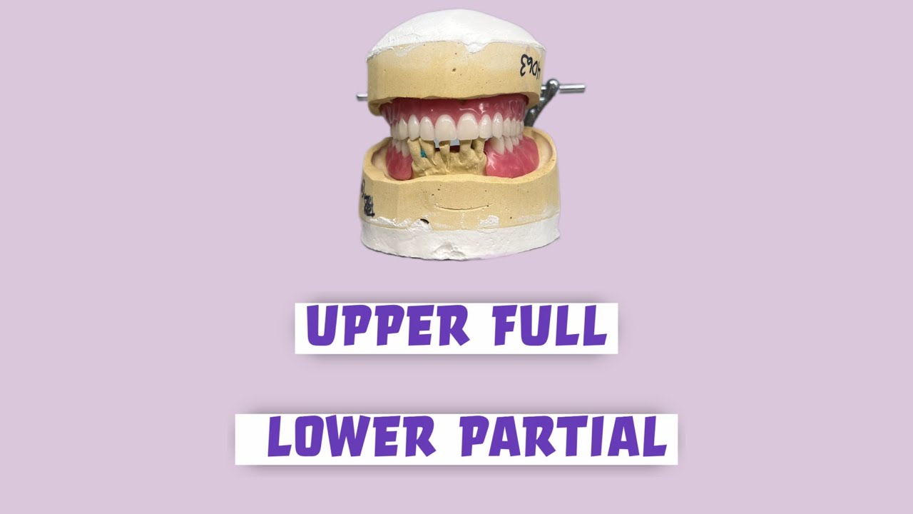 Wax-Up in Progress 🦷 Upper Full / Lower Partial