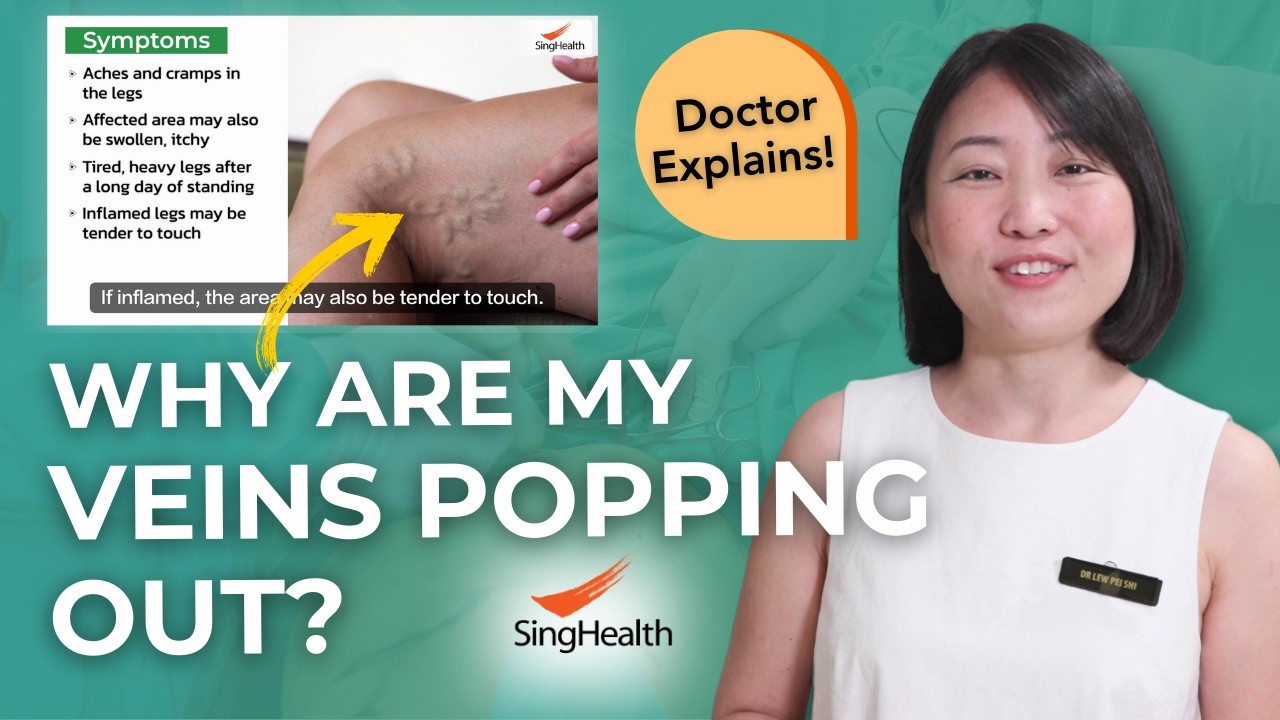 Varicose Veins: How to Treat? | Why Are Veins Popping? - Changi General Hospital
