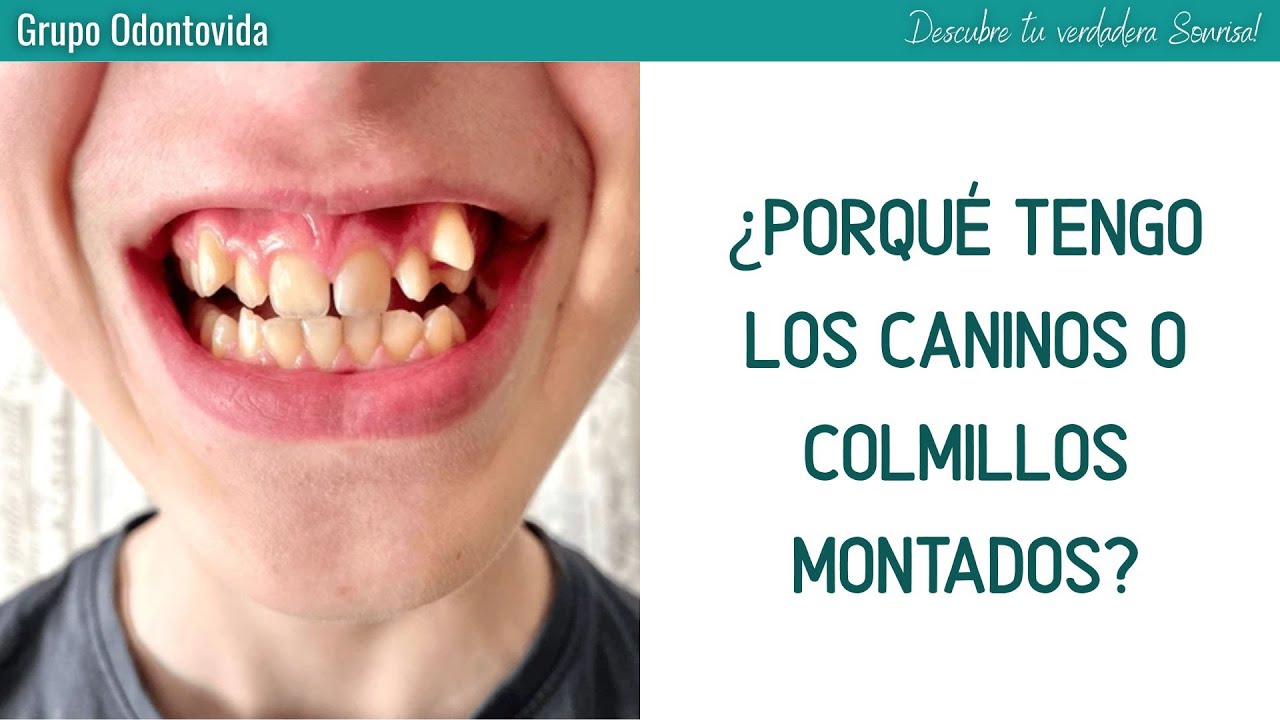 Ortodoncia en Niños y Adolescentes: ¿Porqué tengo los caninos o colmillos montados?