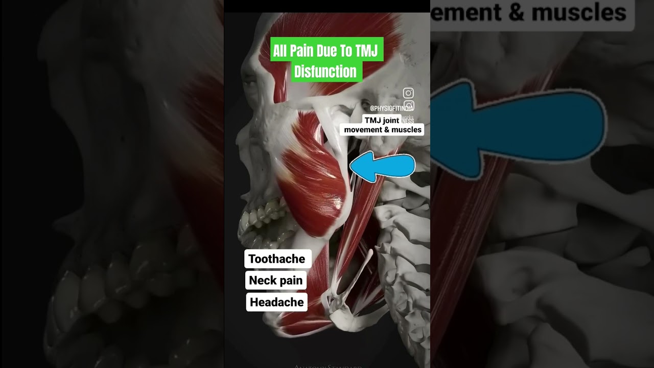 TMJ Cause neck pain , headaches , ear pain #TMJRelief #headache #neckpain #cervical #earpain