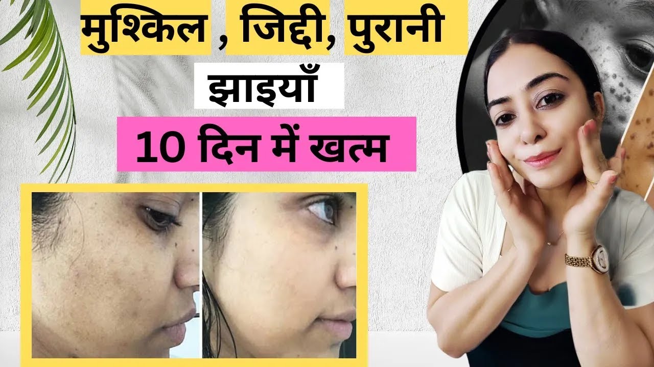 I Tried Pooja Luthra's Pigmentation Treatment for Glowing Skin Here's What Happened