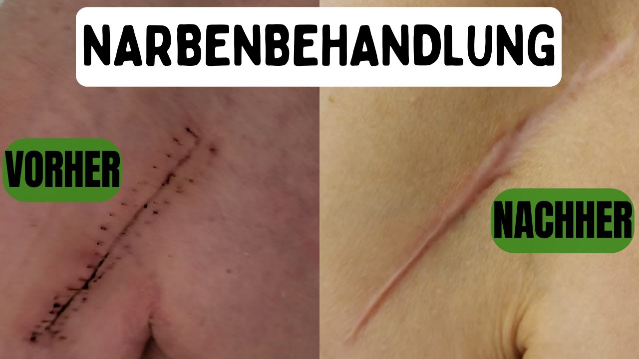 NARBENMASSAGE  SELBER MACHEN  #narbenbehandlung #Narbenpflege#