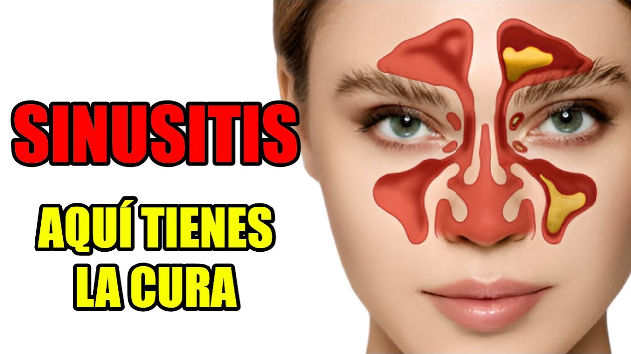 💥 SINUSITIS | ¿Cómo CURAR la SINUSITIS rápido? Sigue estos pasos