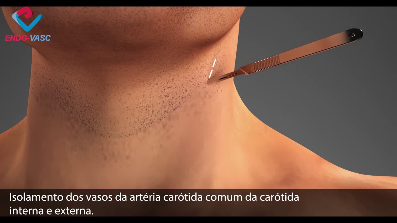 Endarterectomia De Carótida
