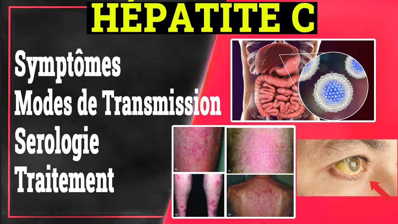 Hépatite C: Symptômes, Transmission, Traitement.. | Gastrologie Médicale