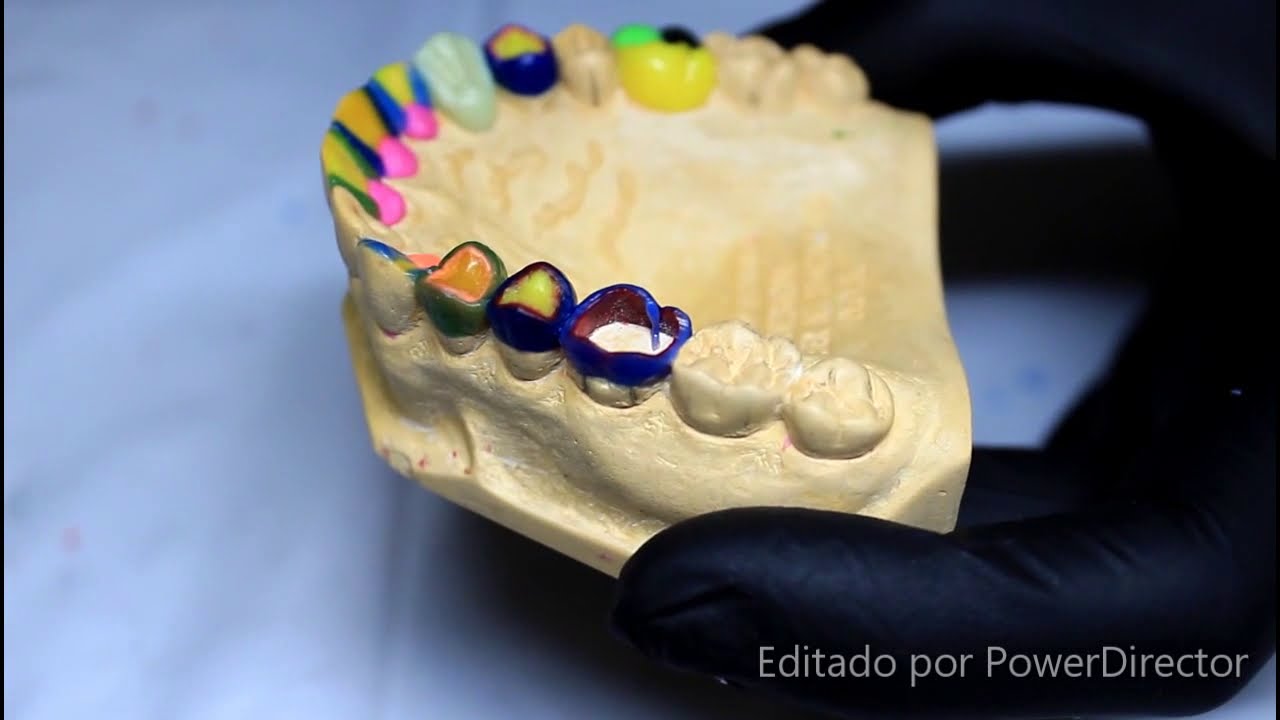 ENCERADO PRIMER MOLAR SUPERIOR