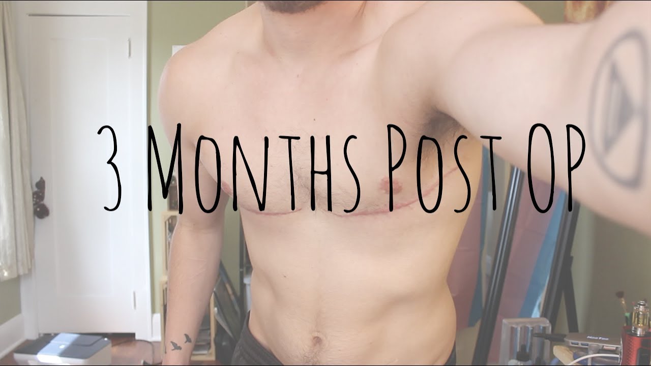 Top Surgery - 3 Months Post OP