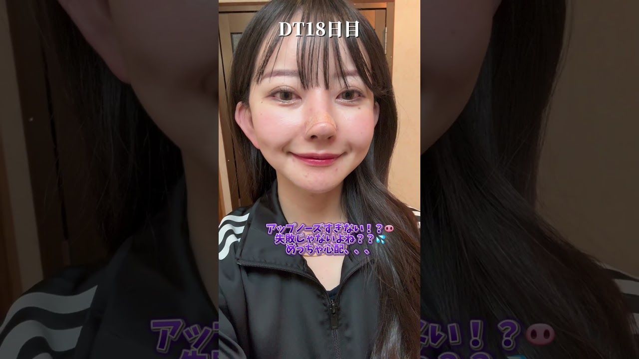 【鼻整形】中国で鼻修正してから㊗️1ヶ月経ったよ〜経過見せます！ #美容整形