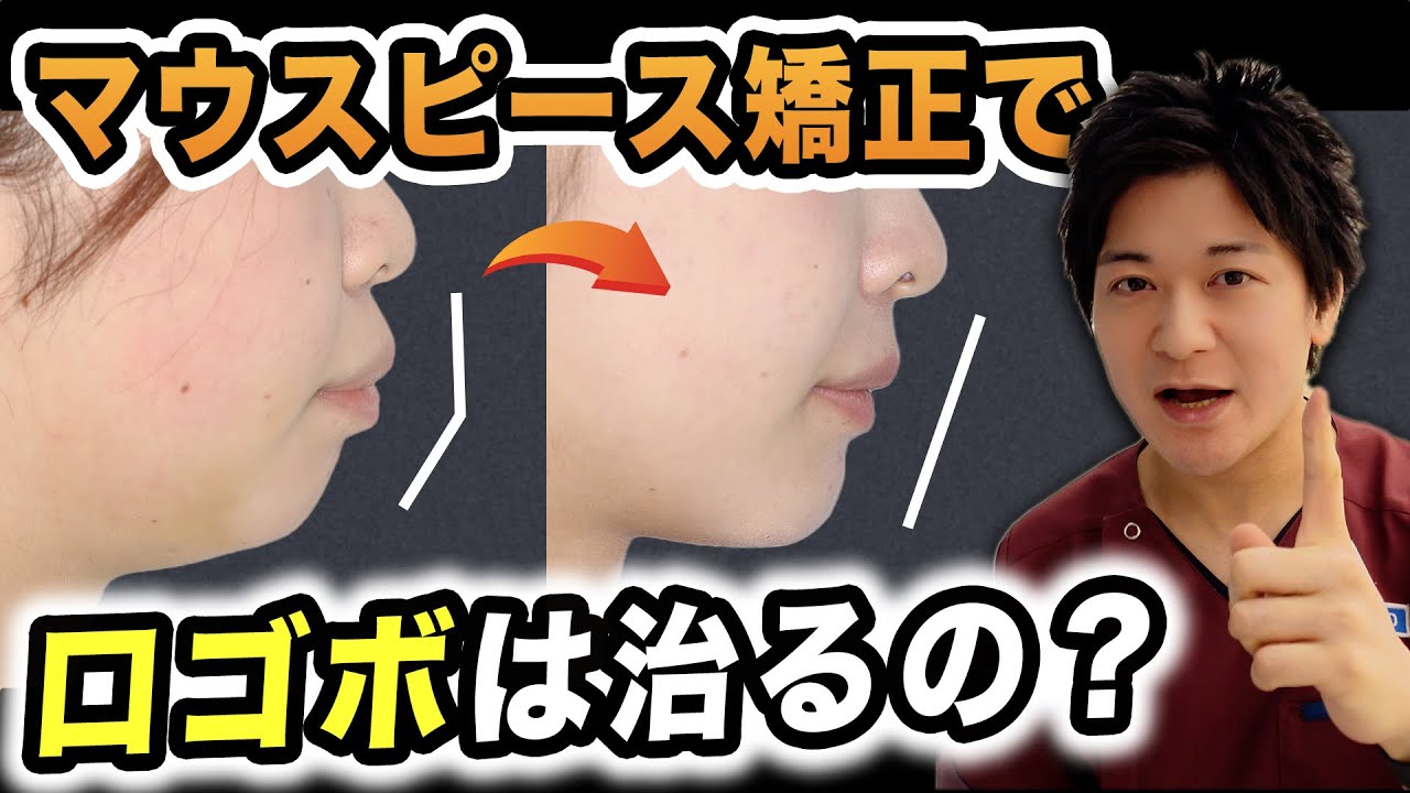 【口ゴボ治療】マウスピース矯正で口ゴボは治るの？