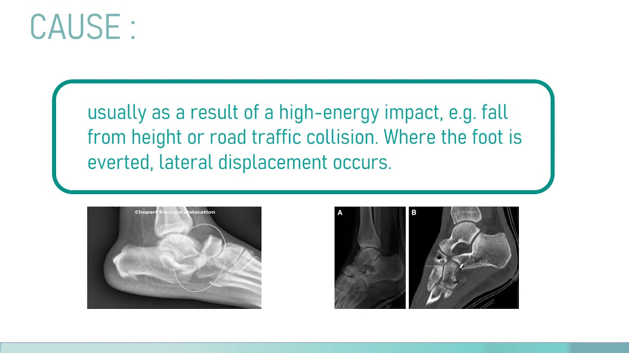 Chopart fracture-dislocations
