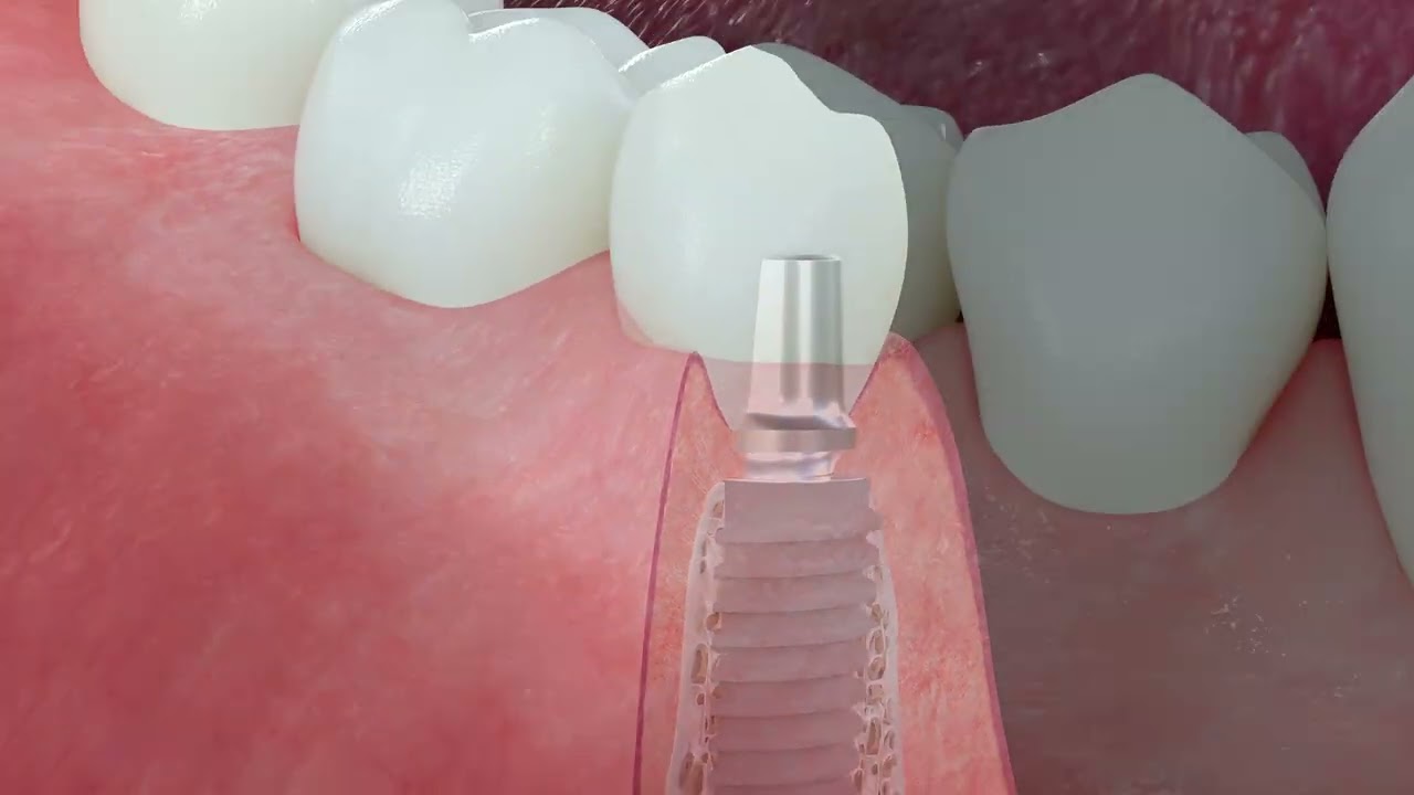 Anatomy of Peri-implant Tissues